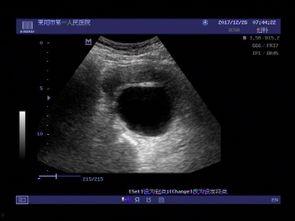 阑尾囊肿可以吃蜜瓜吗,阑尾囊肿患者蜜瓜食用指南